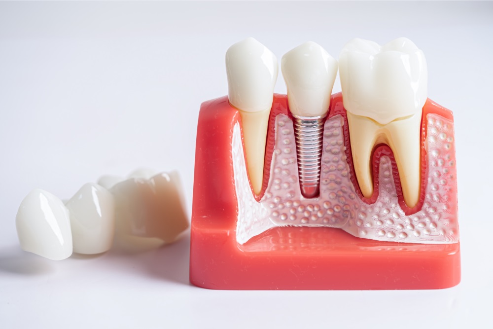 Cum influențează un implant dentar psihicul pacientului?